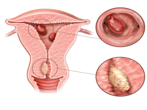 Polyp of Uterus KNOW MORE