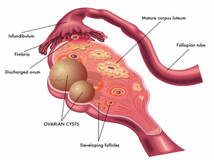 Ovarian Cyst KNOW MORE