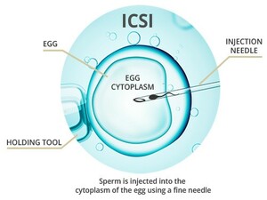 Intra Cytoplasmic Sperm injection(ICSI) KNOW MORE