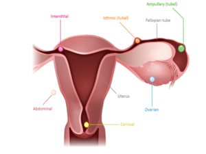 Abnormal Bleeding KNOW MORE