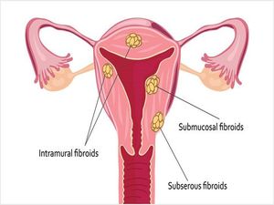 Fibroids KNOW MORE