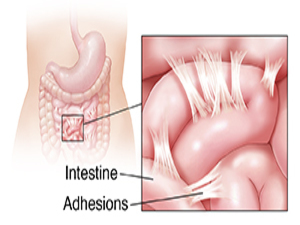 Pelvic Adhesions KNOW MORE